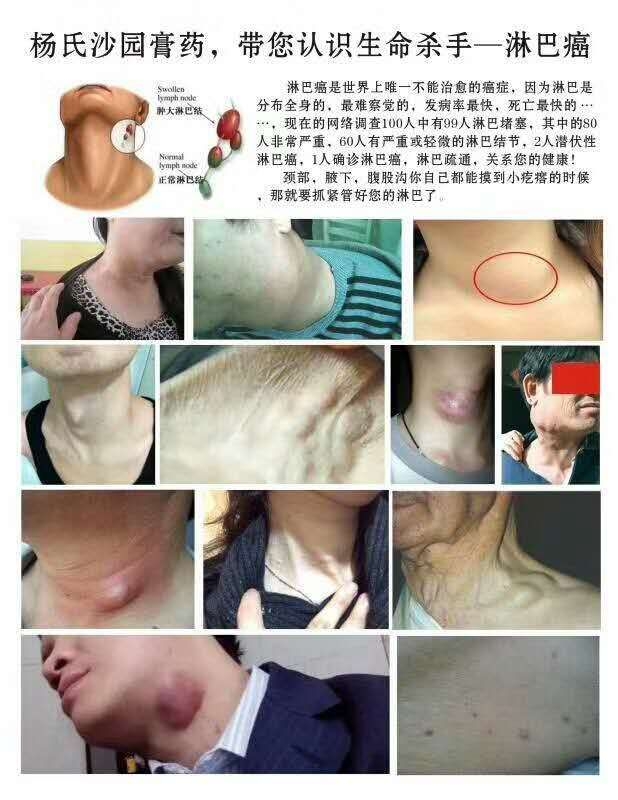 预防淋巴瘤最好的方法是什么?